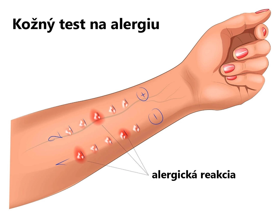 Bepotastine and its role in treating chronic urticaria