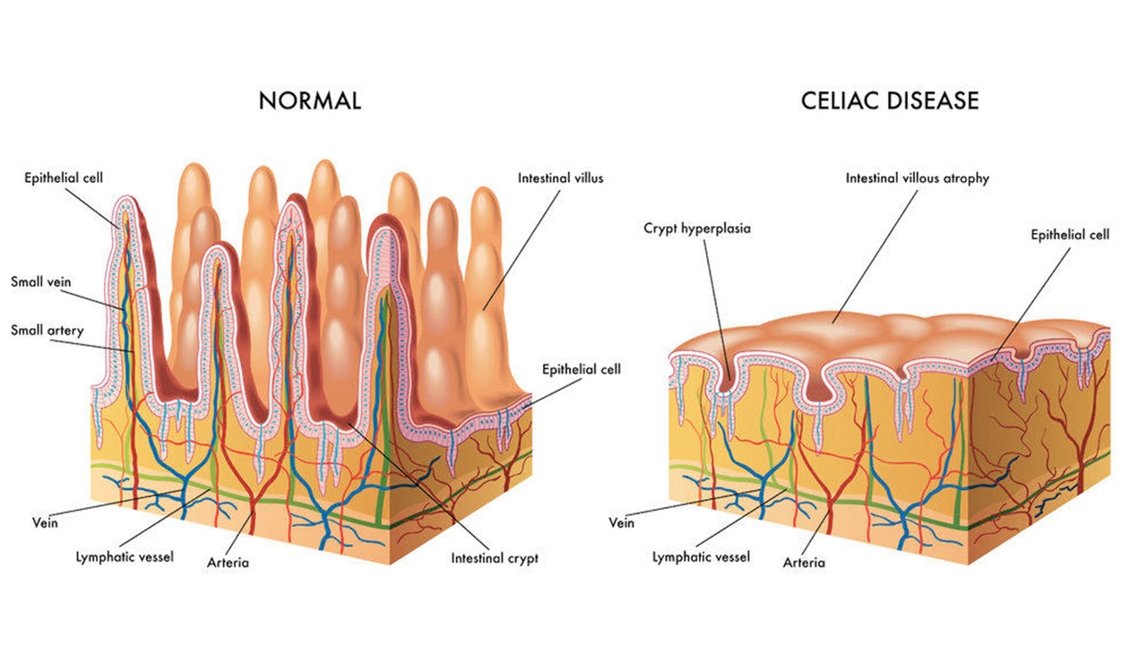 Aspirin and celiac disease: Is it safe for those with gluten sensitivities?