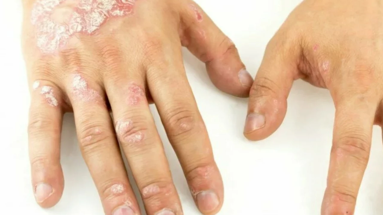 Understanding Plaque Psoriasis: Causes, Symptoms, and Treatments